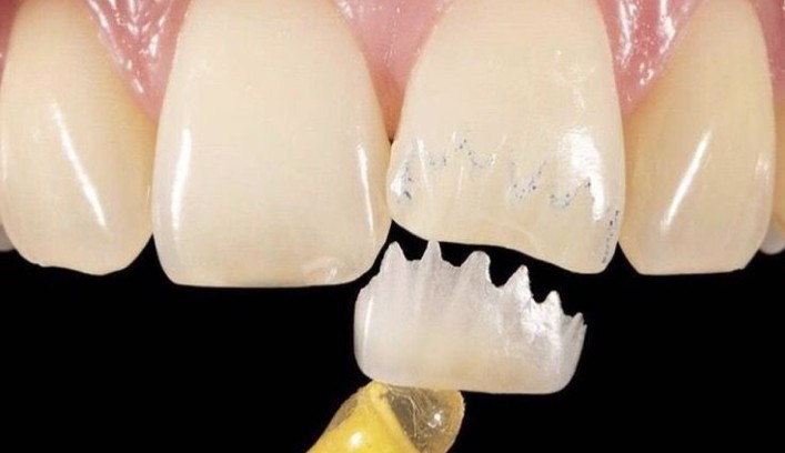 Восстановление зуба: какой метод выбрать?