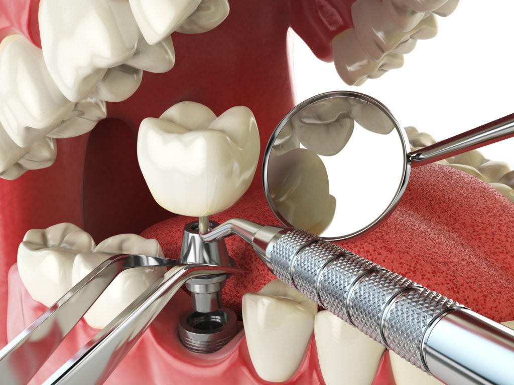 Імплантація зубів в Броварах
