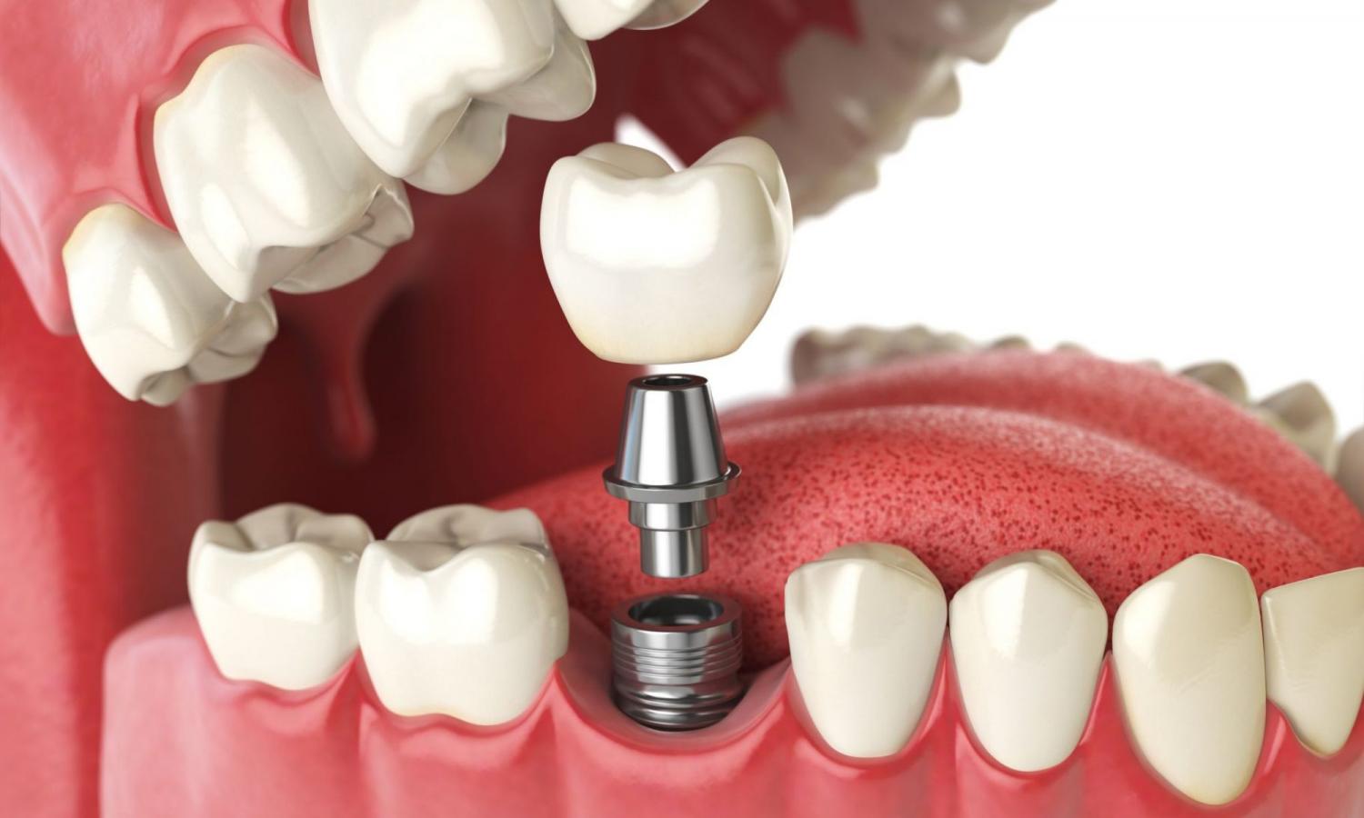 Как проходит процедура по имплантации зубов