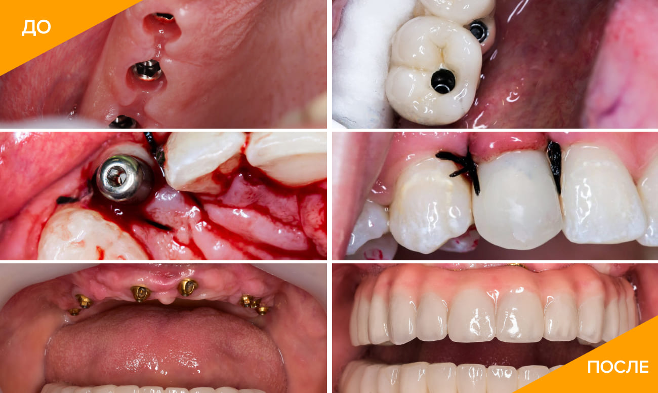 Как проходит процедура по имплантации зубов
