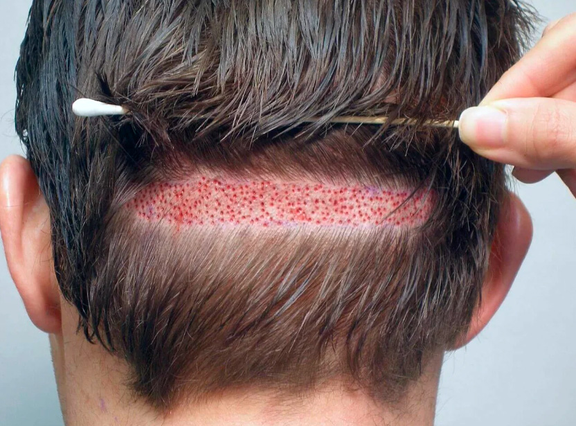 Безопасный и эффективный FUE метод пересадки волос