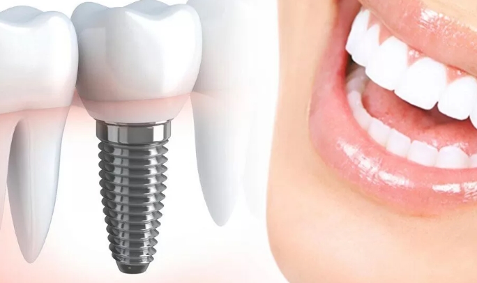Сколько стоит имплант зуба в Краснодаре