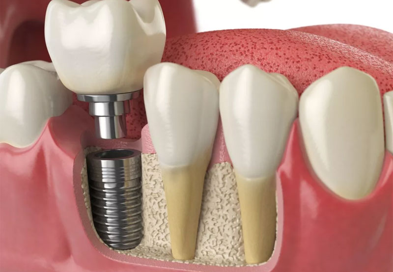 Сколько стоит имплант зуба в Краснодаре