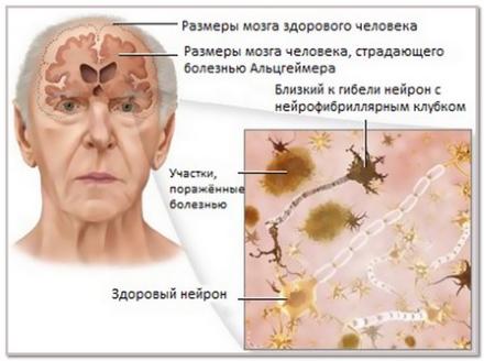Препарат для лечения болезни Альцгеймера испытан на шопоголиках